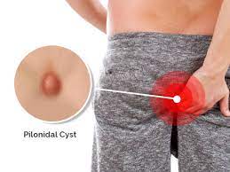 pilonidal cyst symptoms causes