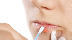 cold sore remes how to treat and