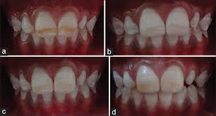 This treatment option of restoring vertical dimensions of occlusion for severe fluorosis patients requires careful investigations and preparation. A Comparison Of Various Minimally Invasive Techniques For The Removal Of Dental Fluorosis Stains In Children Gupta A Dhingra R Chaudhuri P Gupta A J Indian Soc Pedod Prev Dent
