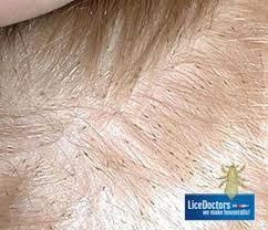 Finding three forms of lice which are nits, nymphs and lice will be a little bit harder when your hair has these dark tones because many people can sometimes mistake these with something else such as dandruff. Nits Appear Brown When Against A Light Background Fort Meyers And Naples Head Lice Nits Lice Nits Head Louse