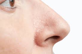 psoriasis on the nose causes