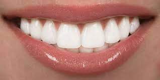 how white is too white for your smile