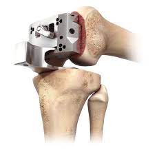 depuy attune knee replacements tibial