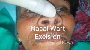 nasal wart excision you