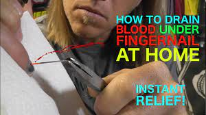 how to drain blood under finger nail at