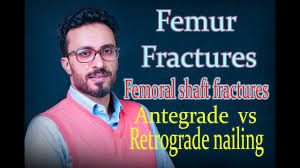 05 femur fractures antegrade vs