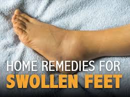 home remes for swollen feet