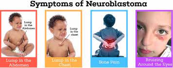 Secondhand smoke and the harmful chemicals in it are known causes of sudden infant death syndrome, respiratory infections, ear infections, and asthma attacks in infants and children. Neuroblastoma Childhood Cancer Signs And Symptoms Acco
