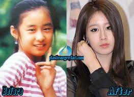 t ara jiyeon plastic surgery before and