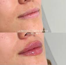 lip augmentation la beauty skin