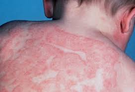 Image result for eczema homeopathy