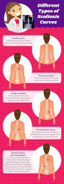 ultimate guide to scoliosis treatment