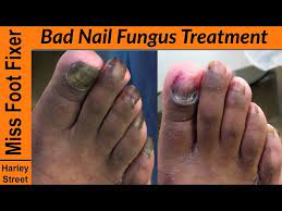 bad toenail fungus treatment how to