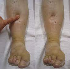 leg edema swelling treatment