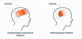 proton therapy and use of cyclotrons