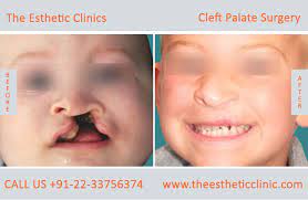 best cleft palate treatment in mumbai