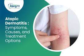 atopic dermais symptoms causes