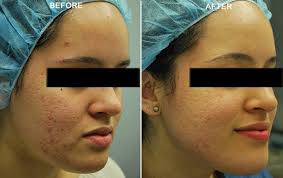 large pores treatment man dermatology