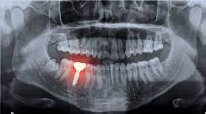 opg cbct scan innovate dental studio