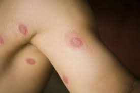 13 causes of red spots on skin