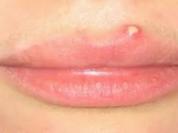 home remes to remove pimples on lip