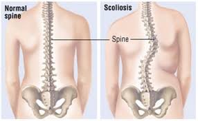 anterior posterior scoliosis correction