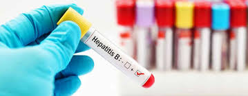 | how many people have hepatitis b? Haartransplantation Und Hepatitis B Clinicana