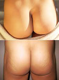 Buttocks - Wikipedia