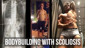 my top 3 exercises for scoliosis