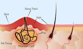 Recurrent follicular infection is the causative factor. Laser Treatment For Pilonidal Sinus In Delhi Laser 360 Clinic