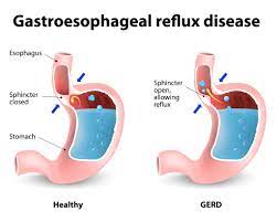 the link between gerd and dentistry