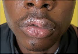 image of centred upper lip scar