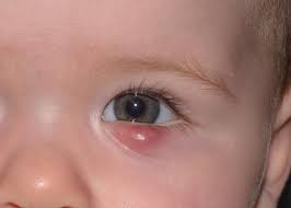 infections of the eye and adnexa in