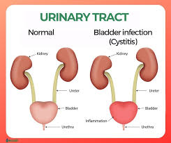 bladder infection cysis symptoms
