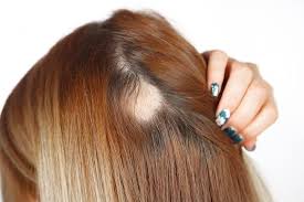 When you have alopecia areata, cells in your immune system surround and attack your hair follicles (the part of your body that makes hair). Alopecia Risk Factors And What To Do About Them Honest Hair Restoration Hair Transplant Specialists