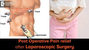gas after laparoscopic surgery