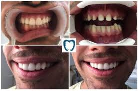 Zirconium Crowns Dental Clinic Turkey Cosmetic Dentistry