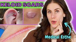 how to treat keloid scars at home is