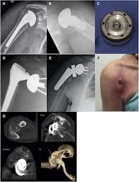 the painful shoulder arthroplasty