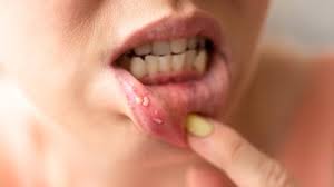 causes and prevention of mouth cancer