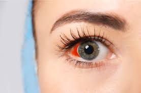are broken blood vessels in your eye