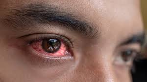 home remes to treat bloodshot eyes