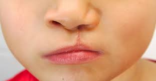 cleft lip and cleft palate alabama