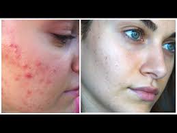 open pores acne scaring rubygolani