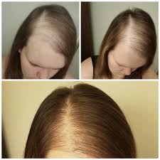 Female pattern baldness is a type of hair loss that affects women. Beginning 3mo And 6mo After Treatment For Female Pattern Baldness Femalehairloss