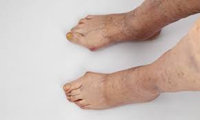 enfermedades del pie podología