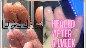 eczema natural treatment teaser