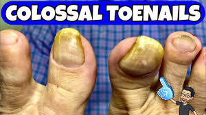 huge toenails debridement long time