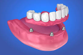 Implant Supported Dentures Melrose