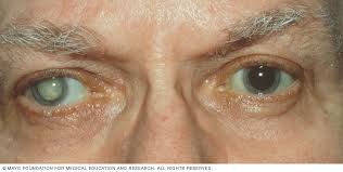 Cataracts Symptoms And Causes Mayo Clinic